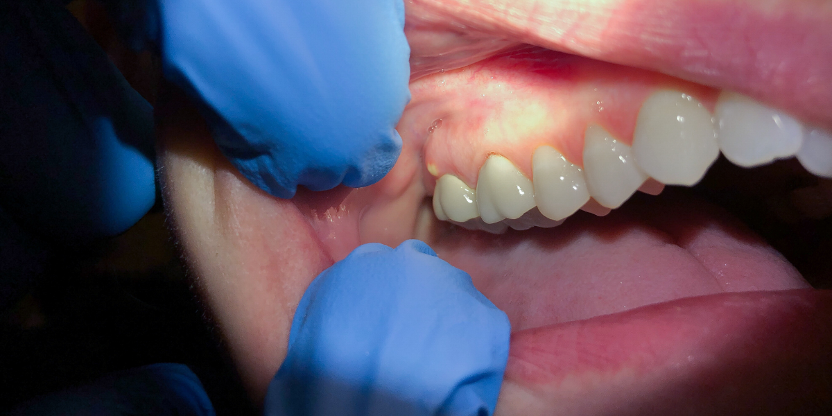 absceso dental 