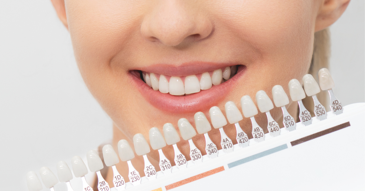10 mitos y verdades sobre el blanqueamiento dental