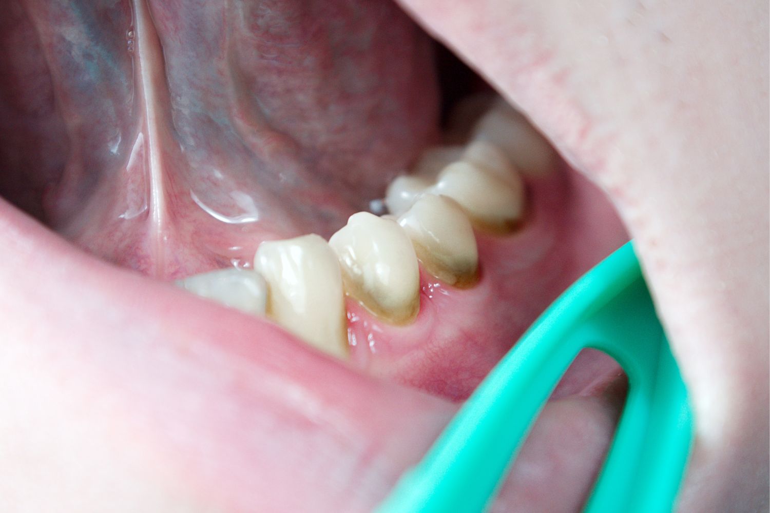 periodontitis sintomas