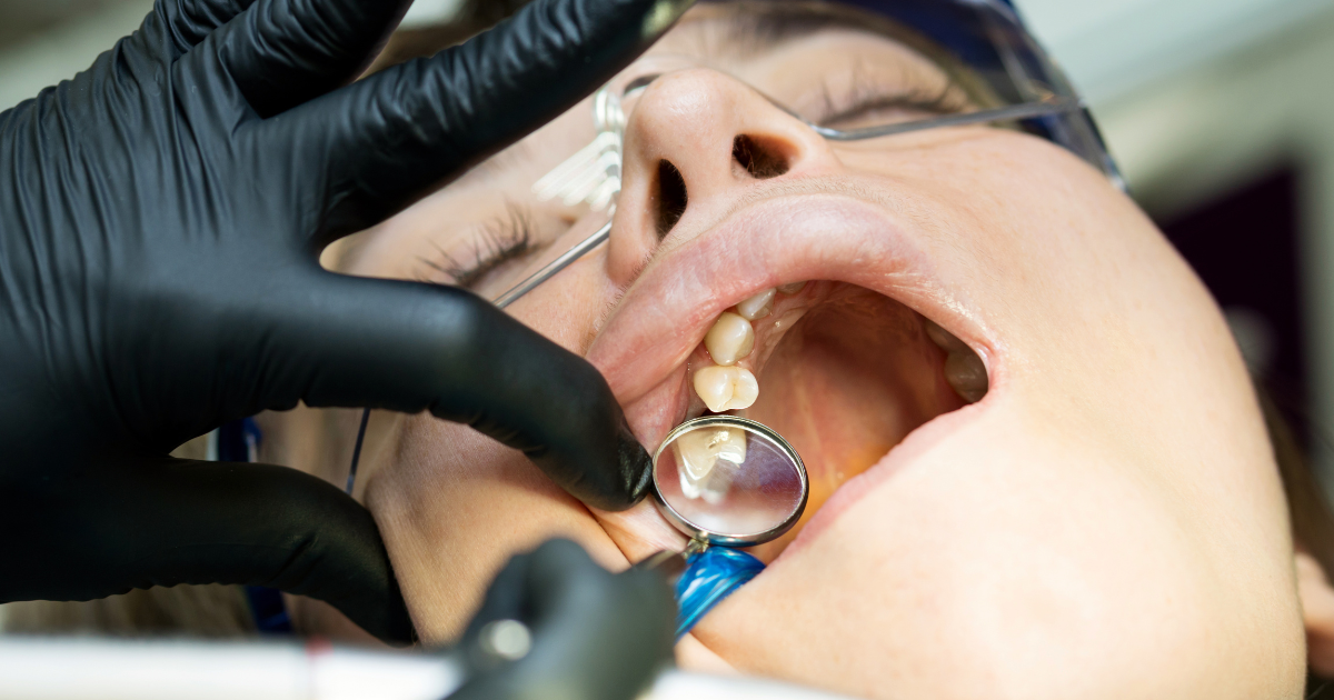 ReabsorciÃ³n dental: causas, prevenciÃ³n y tratamientos disponibles
