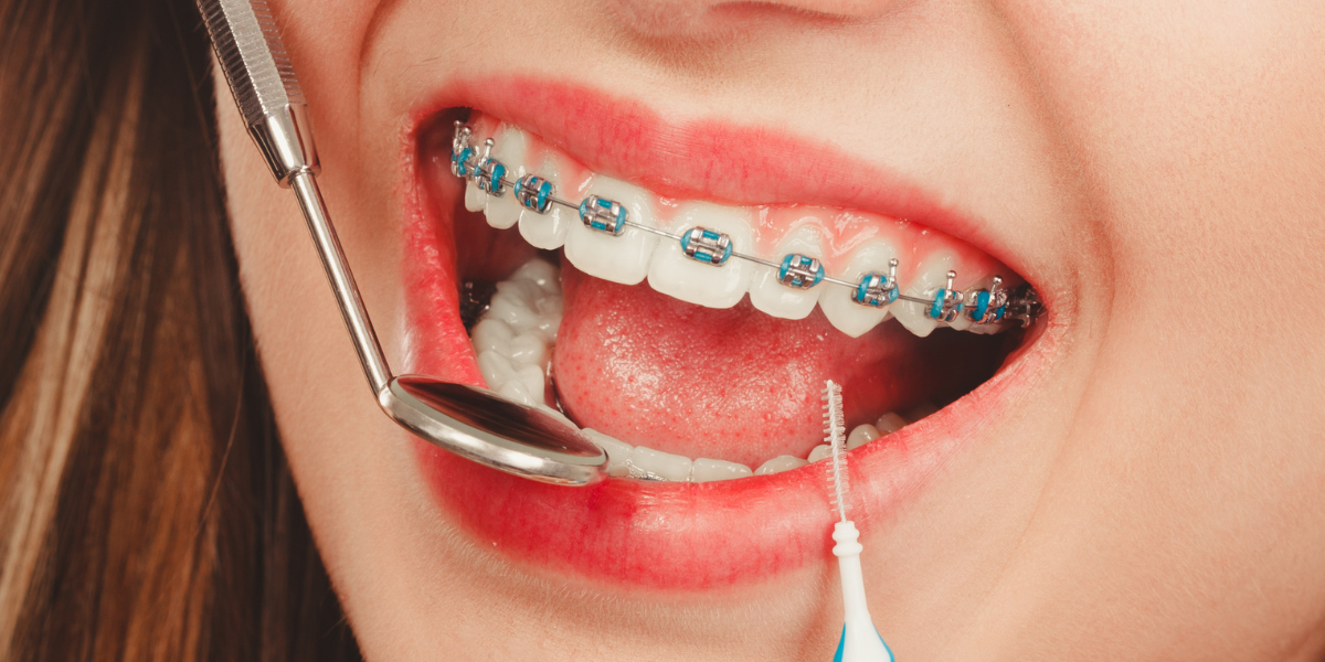 Cómo mantener una buena higiene bucodental con brackets metálicos