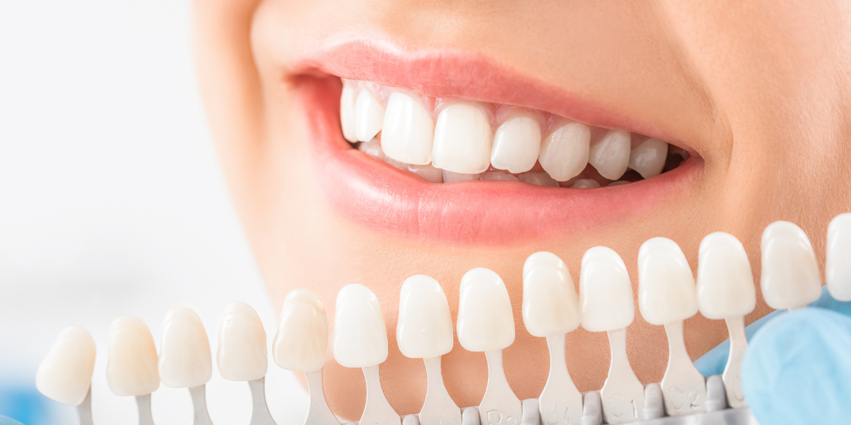 Cuidado posterior al blanqueamiento dental: Consejos para mantener una sonrisa brillante