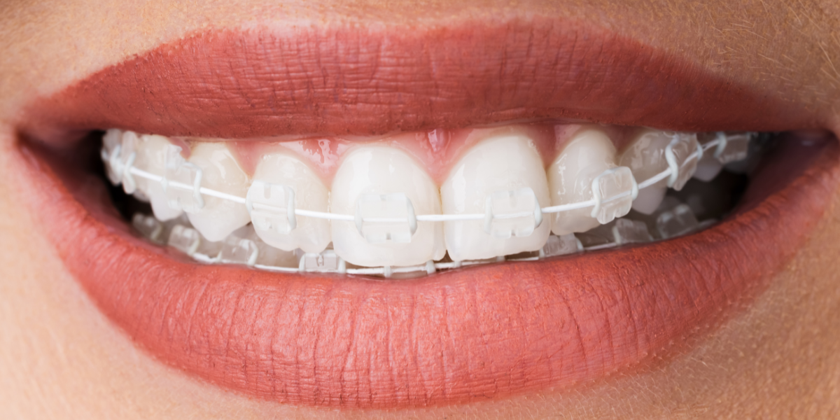 alternativas a los brackets tradicionales