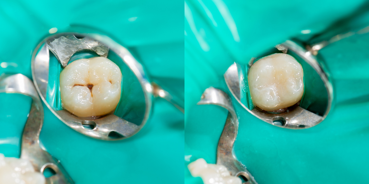 Tipos de restauraciones dentales: Empastes, Coronas e Implantes