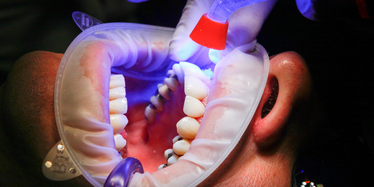 duracion empaste dental